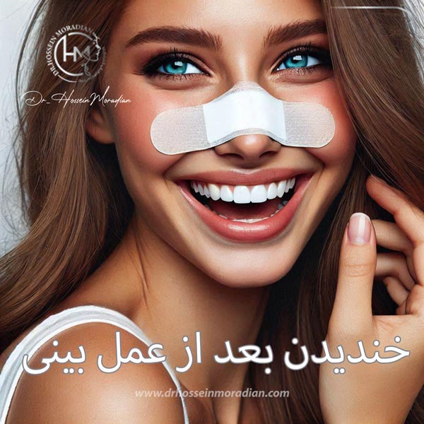 خندیدن بعد از عمل بینی - دکتر حسین مرادیان