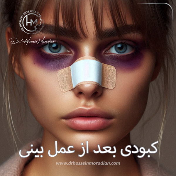 کبودی بعد از عمل بینی - دکتر حسین مرادیان 