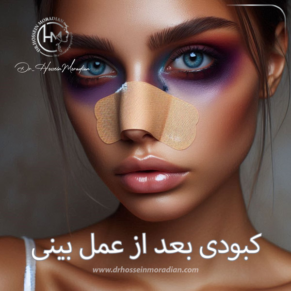 کبودی بعد از جراحی بینی - دکتر حسین مرادیان 