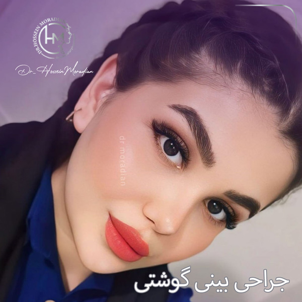 عمل بینی گوشتی | دکتر مرادیان