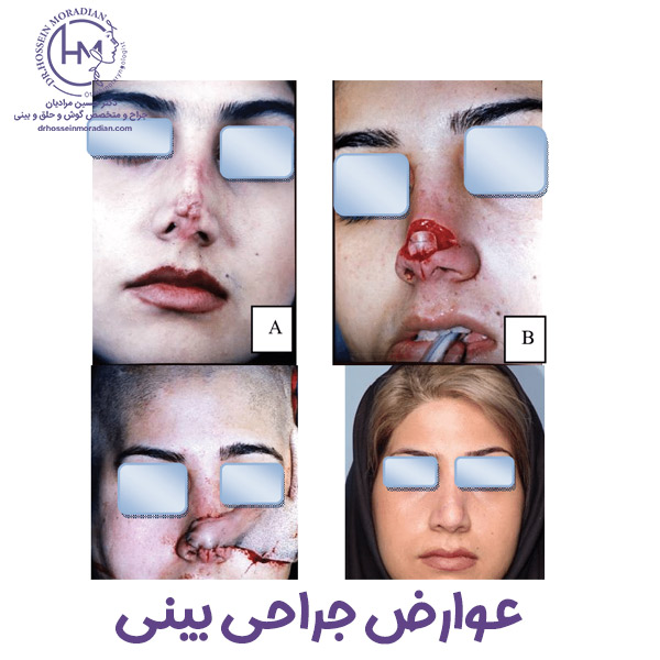 عوارض عمل بینی - دکتر مرادیان
