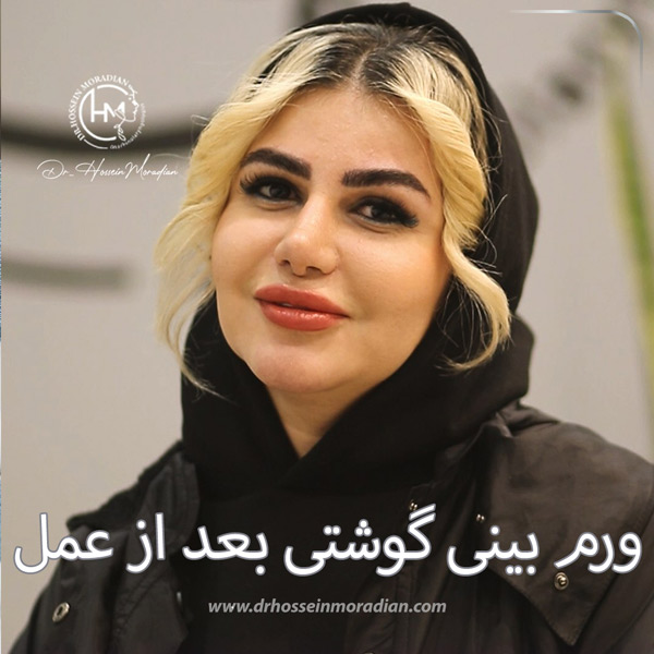 ورم بینی گوشتی بعد از عمل - دکتر جمالی