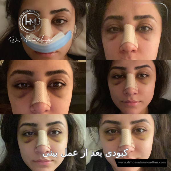 مراحل کبودی بینی بعد از عمل - دکتر مرادیان