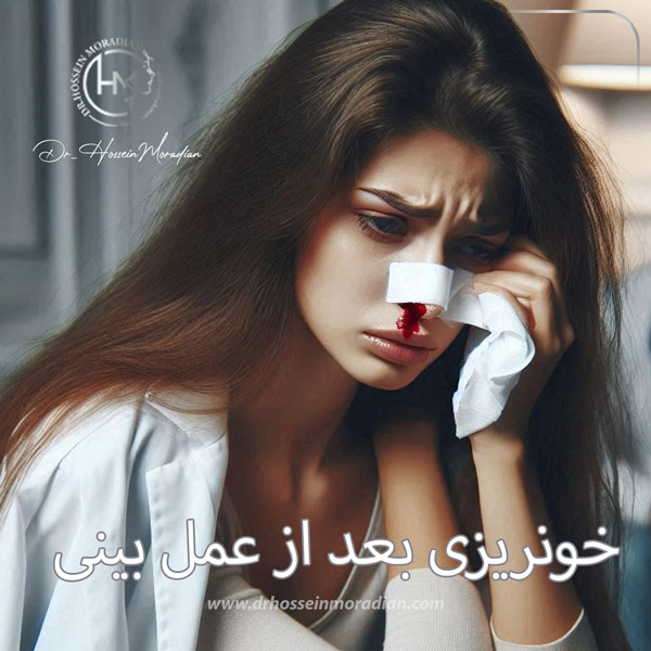 خونریزی بعد از عمل بینی - دکتر حسین مرادیان