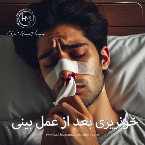 خونریزی بعد از عمل بینی - دکتر حسین مرادیان