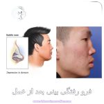 فرورفتگی بینی بعد از عمل - دکتر حسین مرادیان