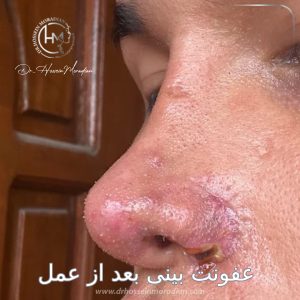 عفونت بعداز عمل بینی - دکتر حسین مرادیان