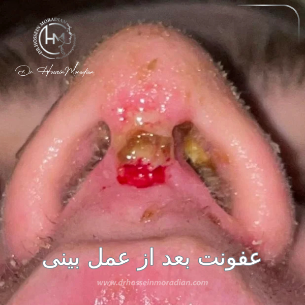 عفونت داخل بینی - دکتر مرادیان