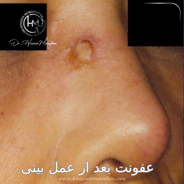 عفونت تیغه بینی - دکتر مرادیان