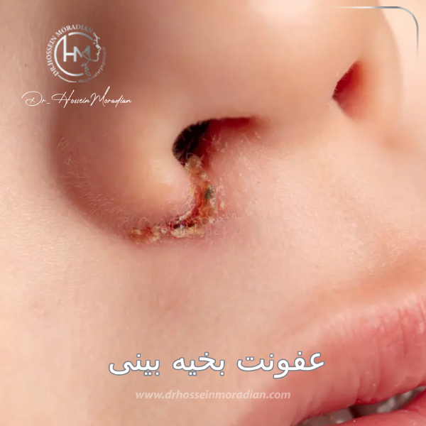 عفونت بخیه بینی - دکتر حسین مرادیان