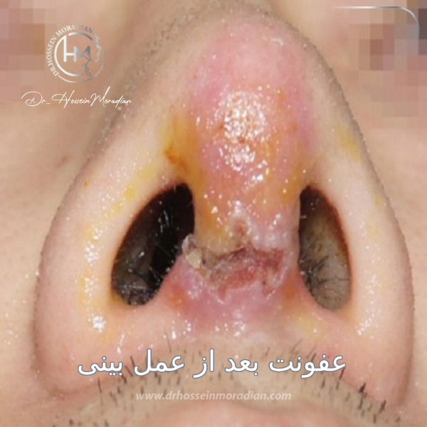 عفونت بعد از عمل بینی - دکتر حسین مرادیان