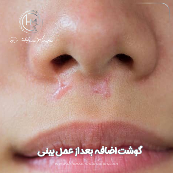 کلوئید و گوشت اضافه بعد از عمل بینی | دکتر مرادیان 
