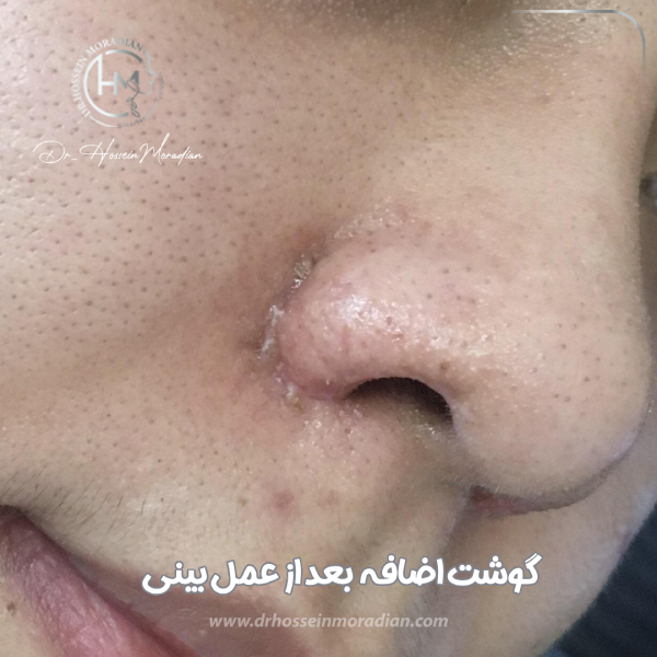 گوشت اضافه بعد از عمل بینی | دکتر مرادیان 