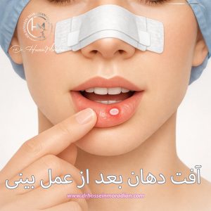 آفت دهان بعد از عمل بینی - دکتر حسین مرادیان