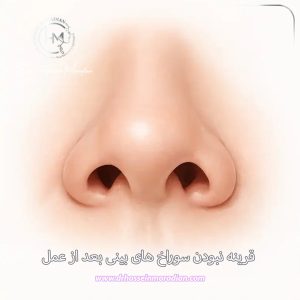 قرینه نبودن سوراخ‌ های بینی بعد از عمل - دکتر حسین مرادیان