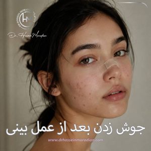 جوش زدن بعد از عمل بینی - دکتر حسین مرادیان