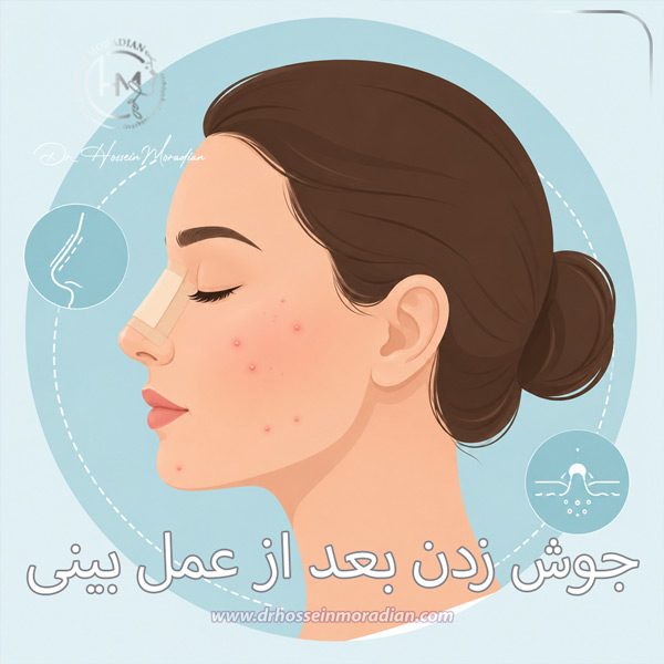 جوش زدن بعد از عمل بینی - دکتر حسین مرادیان