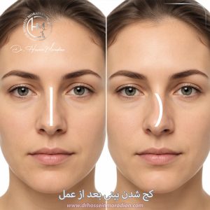 کج شدن بینی بعد از عمل - دکتر حسین مرادیان