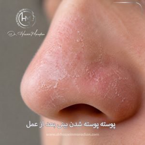 پوسته پوسته شدن بینی بعد از عمل - دکتر مرادیان